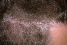 scalp condition - psoriasis